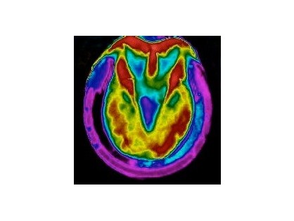 Remarkable changes seen in a mares feet as a result of changing to a BALANCE saddle